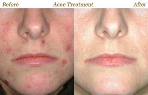 Acne Treatment Before After Photo Minneapolis MN