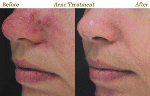 Before After Pictures Acne Therapy Twin Cities MN