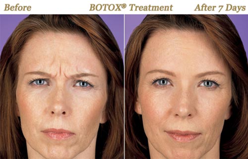 BOTOX Injections Wrinkle Removal Twin Cities MN