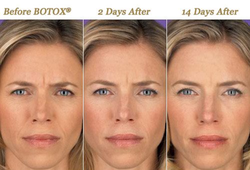 Before After Photo BOTOX Treatments Minneapolis MN