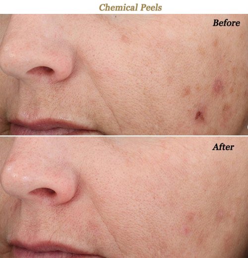 Vitalize Chemical Peels Before After Photos MN