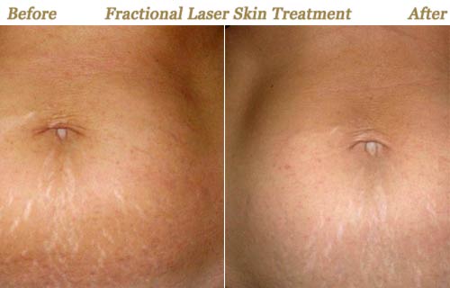 Fractional Laser Skin Treatment for Strectch Marks