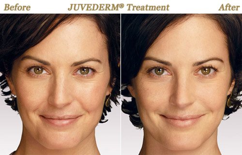 Juvederm Injections Before After Pictures