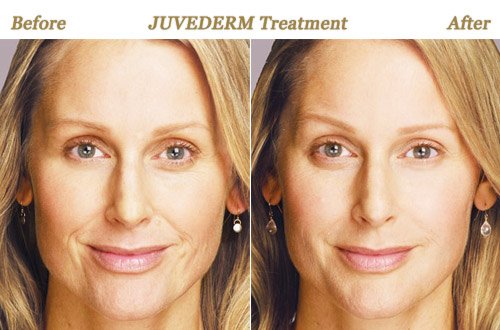 Juvederm Wrinkle Treatment Minneapolis MN