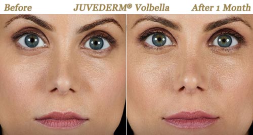 Juvederm Volbella Injections for Fuller Lips Twin Cities MN