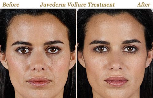 Before After Photos Juvederm Vollure Minneapolis St Paul MN