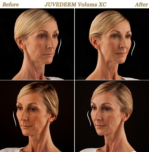 Before After Pictures Juvederm Voluma Injection Minneapolis MN