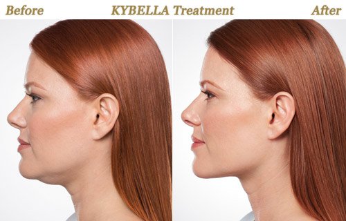 Before After Photos Kybella Injections Minneapolis MN