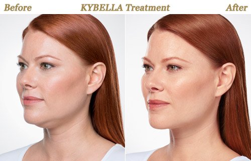 Kybella Treatments Before After Pictures Twin Cities
