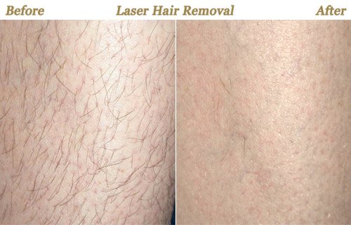 Minneapolis Laser Hair Removal MN