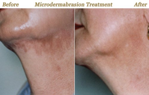Microdermabrasion Treatment Before After Pictures Twin Cities MN