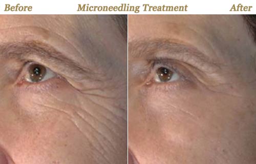 Micro Needling Collagen Induction Therapy MN