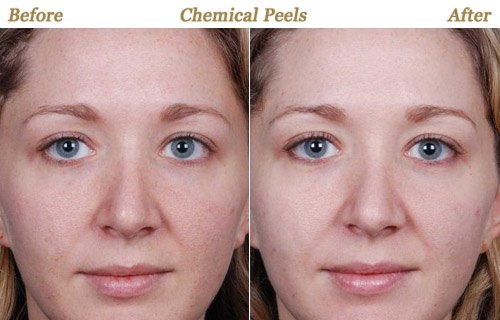 Before After Photos Chemical Peels Minneapolis MN