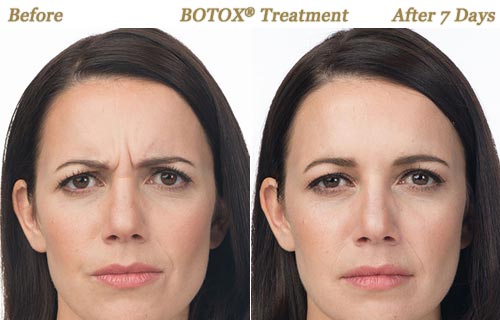 BOTOX Cosmetic Wrinkle Treatment Minneapolis MN