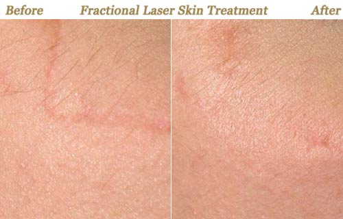 Fractional Laser Resurfacing Treatment for Scar Removal