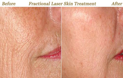 Fractional Laser Skin Wrinkle Reduction Treatment Minneapolis