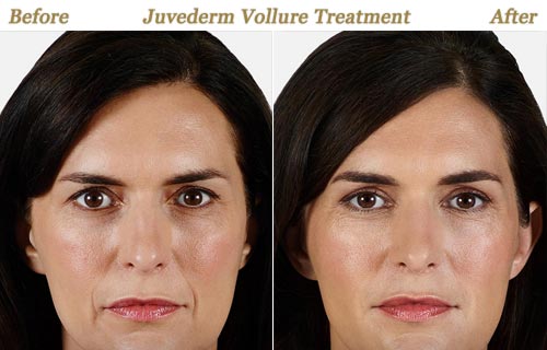 JUVEDERM VOLLURE XC Removes Facial Folds Lines
