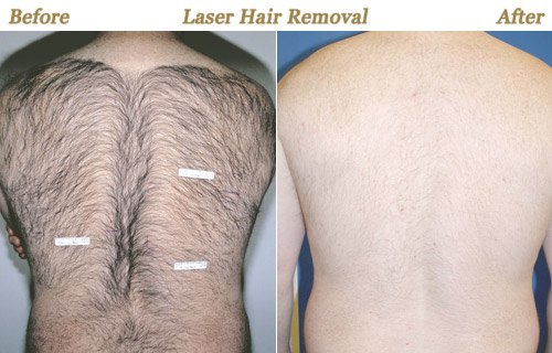 Permanent Laser Hair Removal Twin Cities