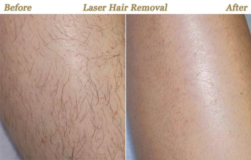 Laser Hair Removal Before After Photos MN