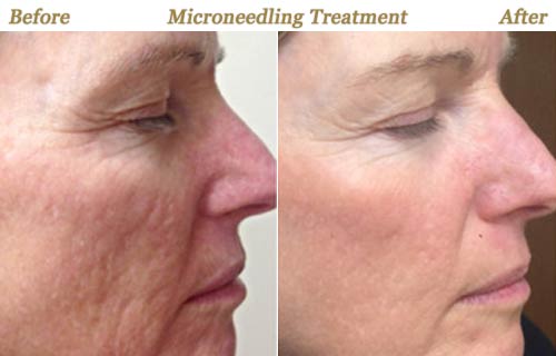 Micro Needling Wrinkle Reduction Treatment Twin Cities