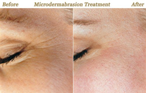 Before After Photos Microdermabrasion Minneapolis MN