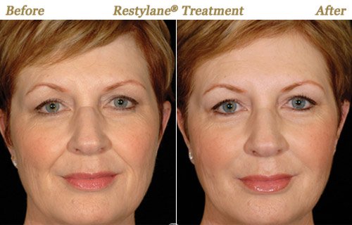 Restylane Injection MN