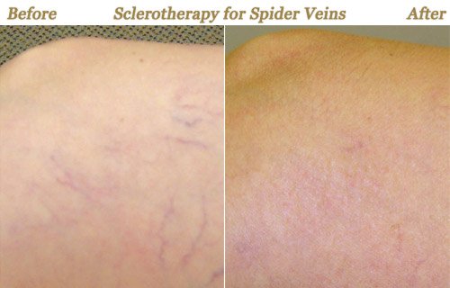 Before After Pictures Sclerotherapy Treatment Minneapolis MN
