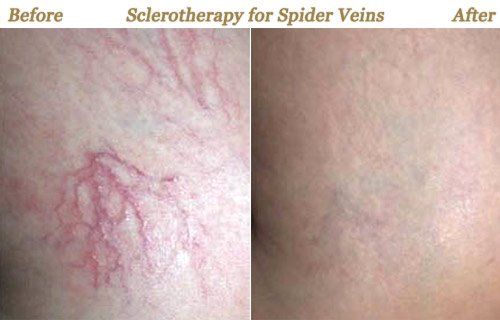 Sclerotherapy Before After Photos Minneapolis MN